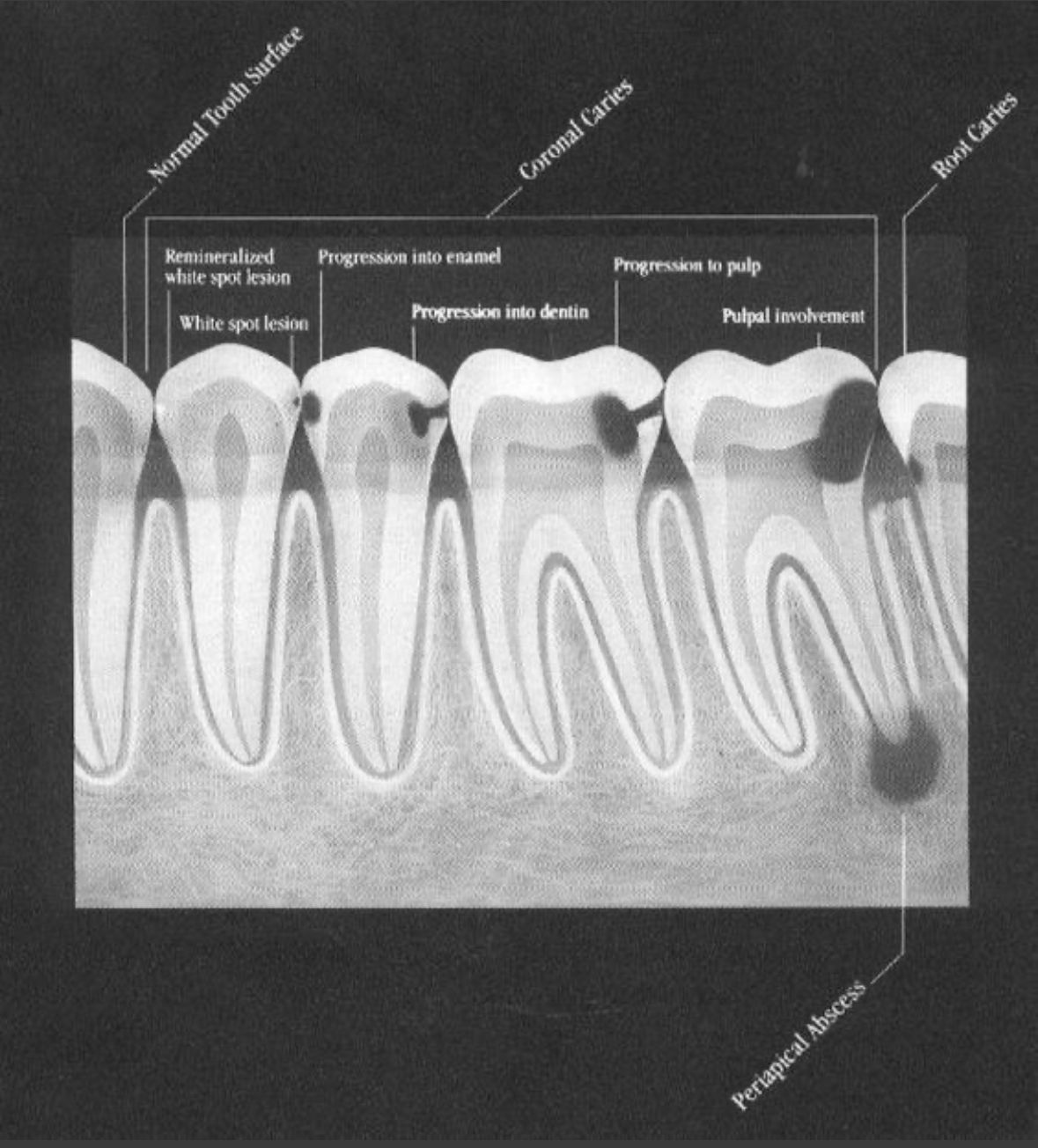 Stages of Tooth Decay 2